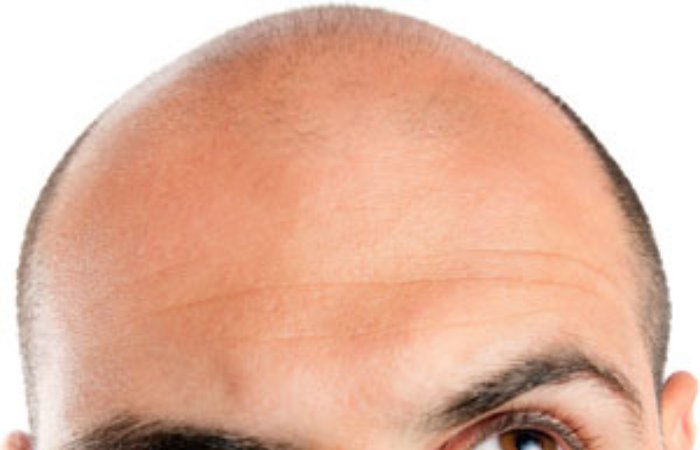 Vücut kıllarından saç ekimi yapılabilir mi?