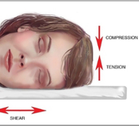 Yüzüstü Ve Yan Yatış Pozisyonunda Uyumak Zamanla Yüzde Çizgilenmelere Neden Oluyor